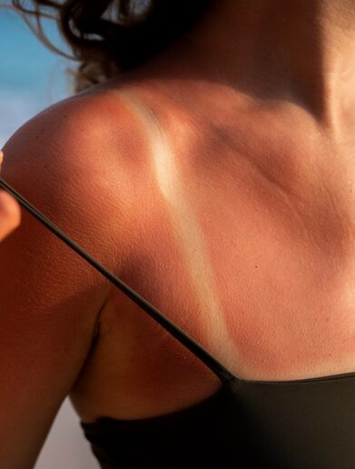 Coup de soleil, causes, précautions et remèdes