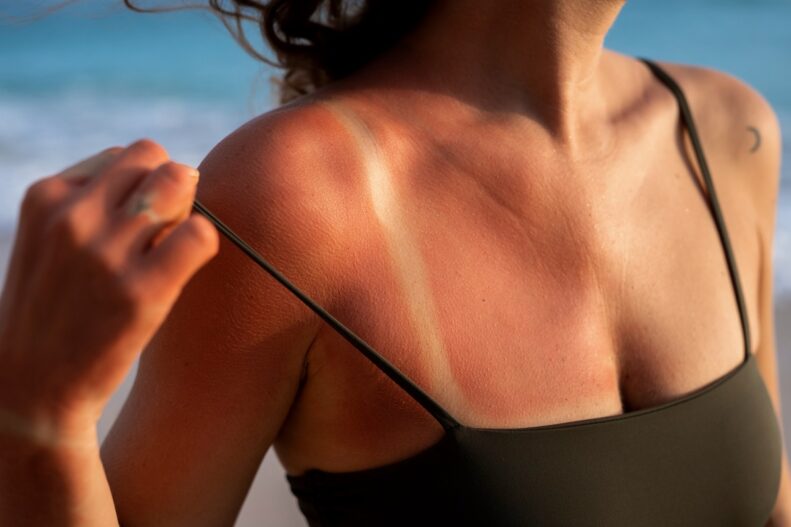 Coup de soleil, causes, précautions et remèdes